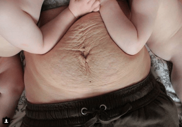 Striae Lees Er Alles Over Op Me To We